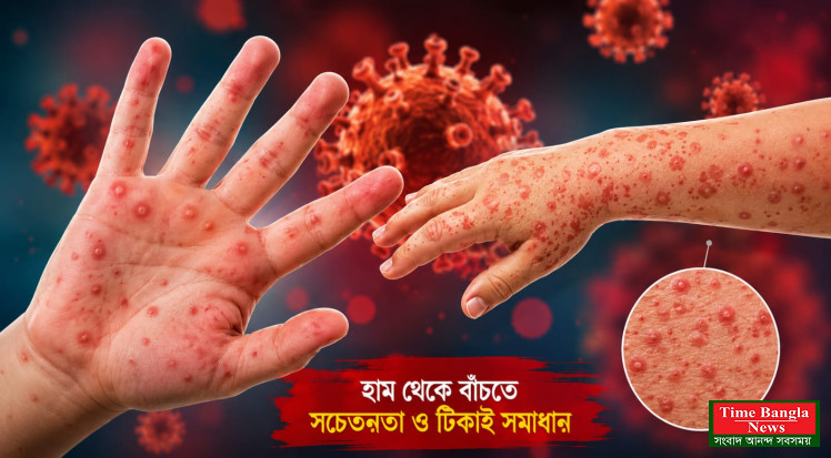 ২৪ ঘণ্টায় হামের উপসর্গে আরও ৪ জনের মৃত্যু, শনাক্ত ১৭০ নতুন রোগী
