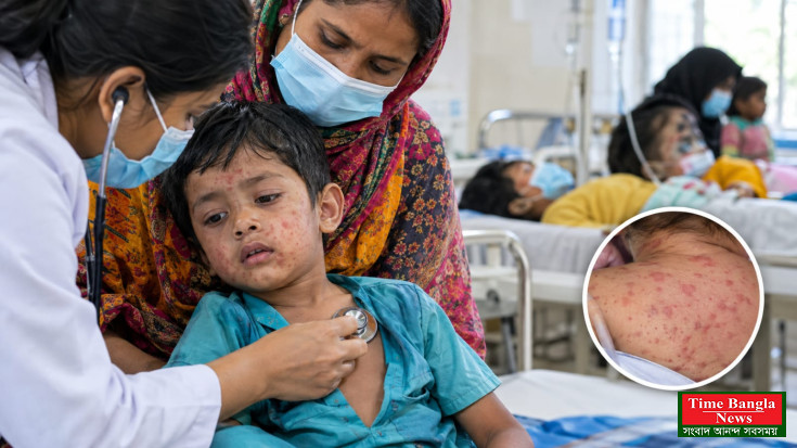 হামের উপসর্গে এক দিনে ৭ জনের মৃত্যু, নতুন আক্রান্ত ১,২৭৩।*